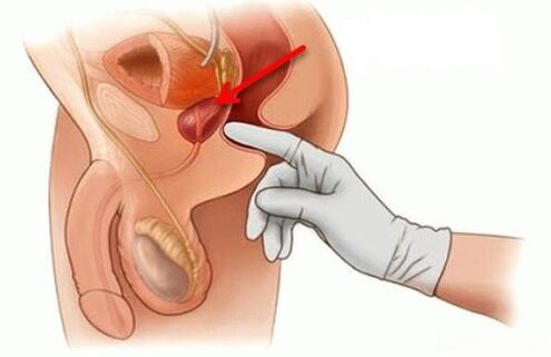 prostatas masāža prostatīta ārstēšanai