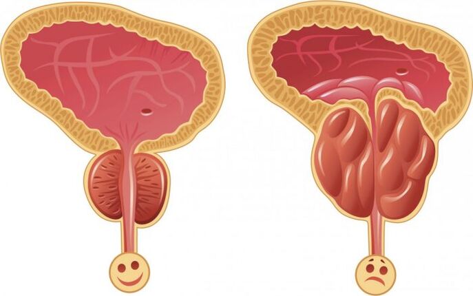 vesela un iekaisusi prostata ar prostatītu